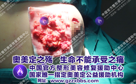 奥美定危害