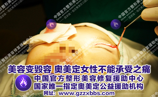 奥美定取出